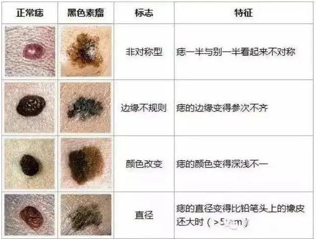 正常的色素痣图片 去掉（正常的色素痣图片 贫血痣）