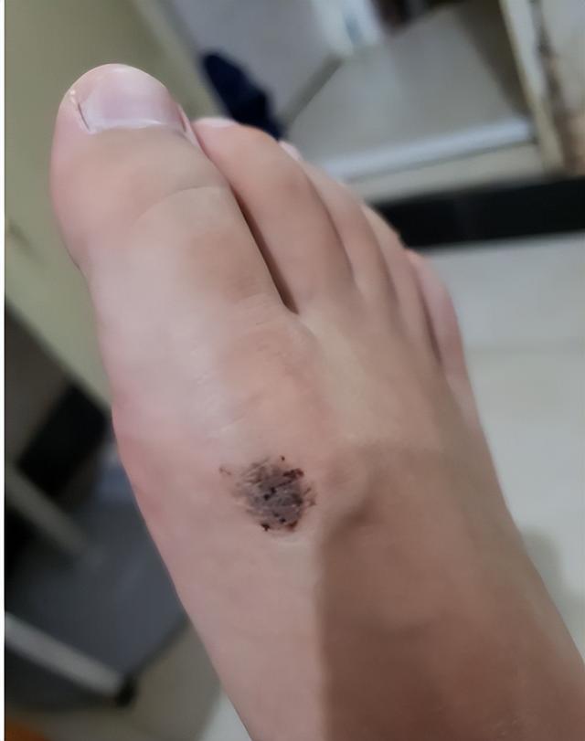 正常的色素痣图片 去掉（正常的色素痣图片 贫血痣）