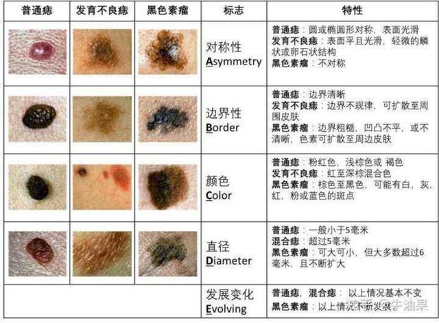 正常的色素痣图片 去掉（正常的色素痣图片 贫血痣）
