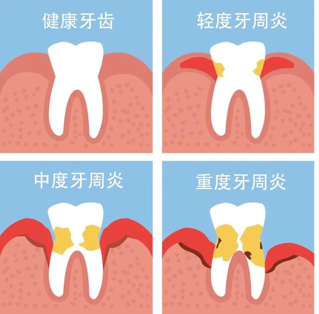 银川拔一颗牙多少钱（小诊所拔一颗牙多少钱）