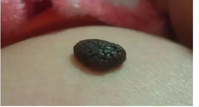 正常的色素痣图片 去掉（正常的色素痣图片 贫血痣）
